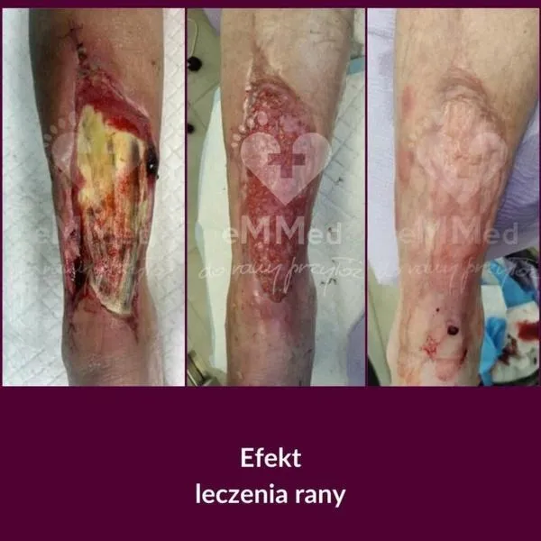 10 kluczowych rodzajów opatrunków, które warto znać dla skutecznej ochrony ran