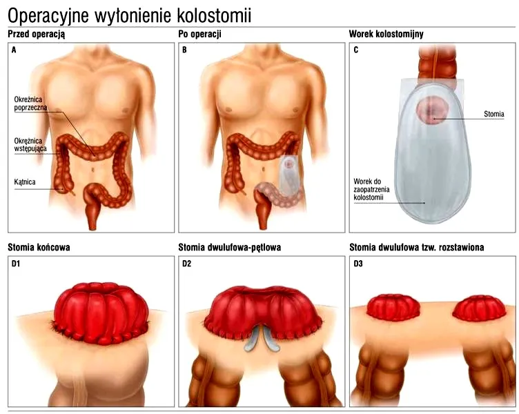 Ile dni w szpitalu po stomii? Odkryj zaskakujące fakty, które musisz znać!