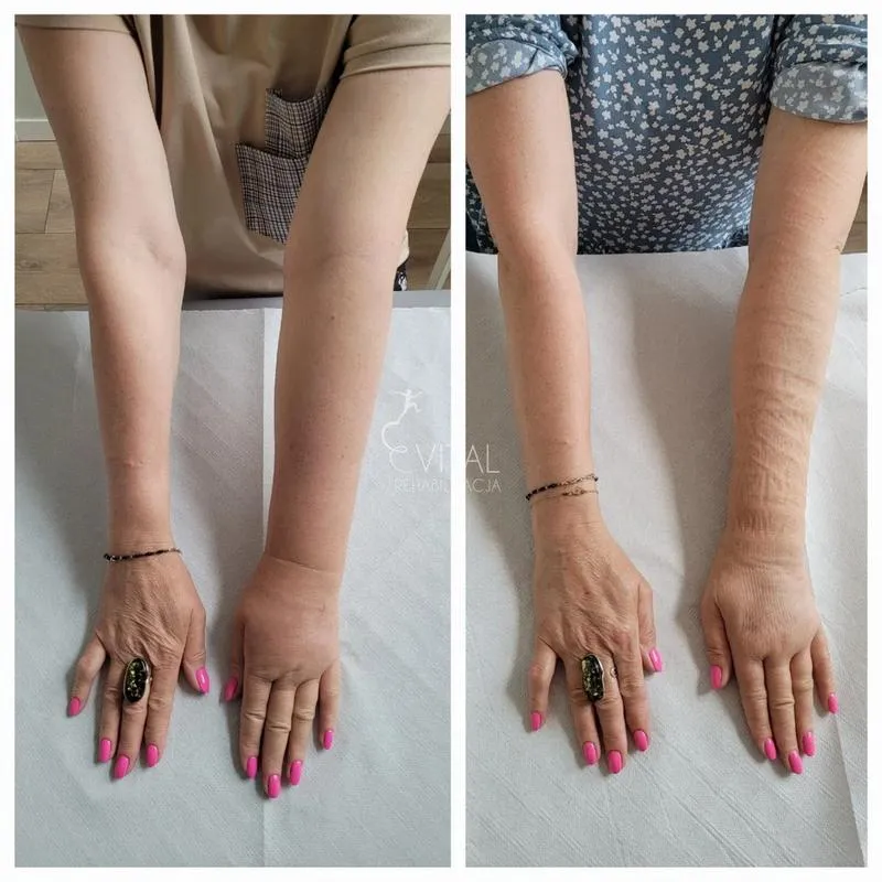 Jak radzić sobie z obrzękiem limfatycznym po mastektomii? Skuteczne sposoby na złagodzenie dolegliwości!