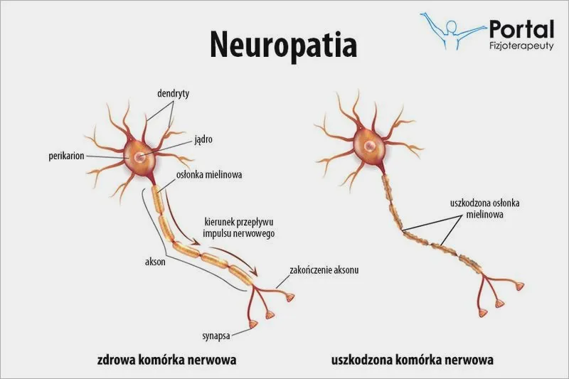 Neuropatia leczenie: jak skutecznie łagodzić dolegliwości?