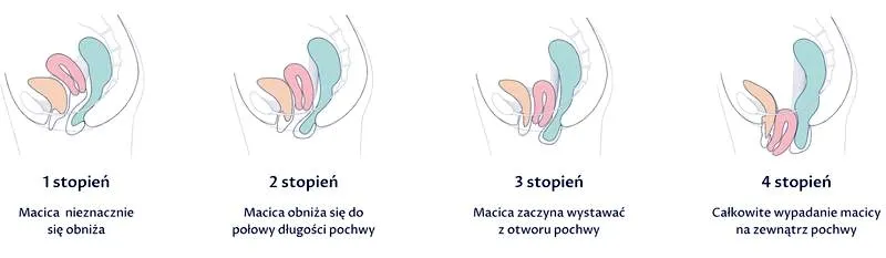 Obniżenie narządów rodnych: 5 niepokojących objawów, o których musisz wiedzieć!