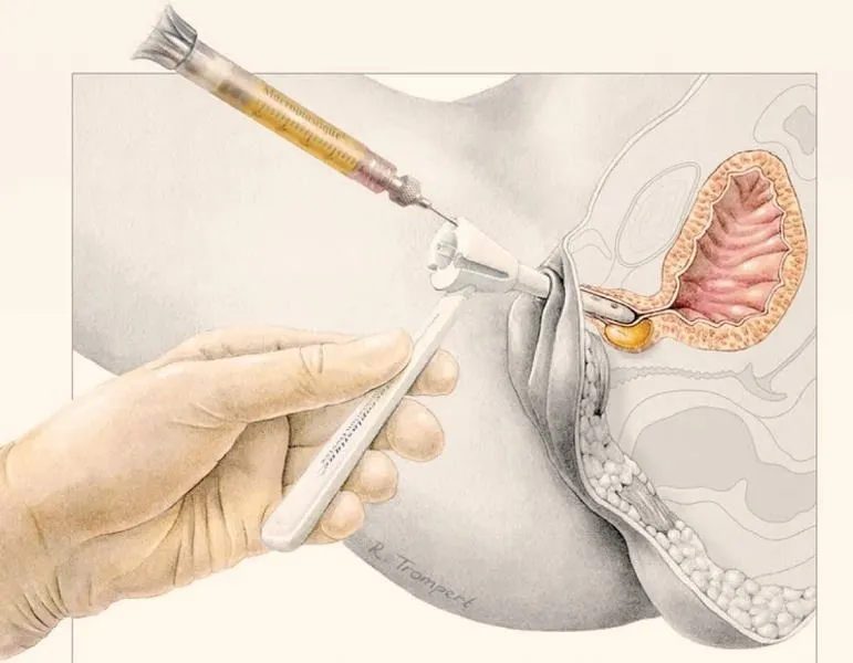 Skuteczne metody leczenia nietrzymania moczu po operacji prostaty – co warto wiedzieć?
