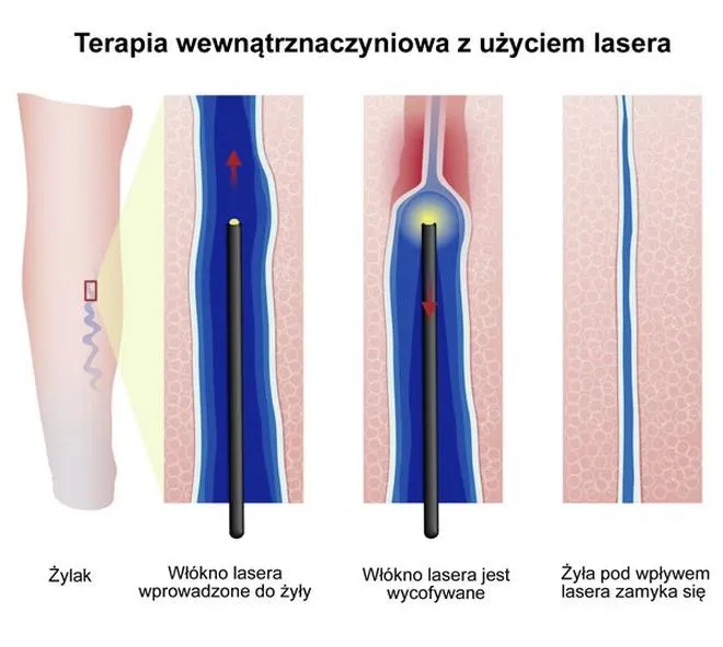 Ablacja laserowa