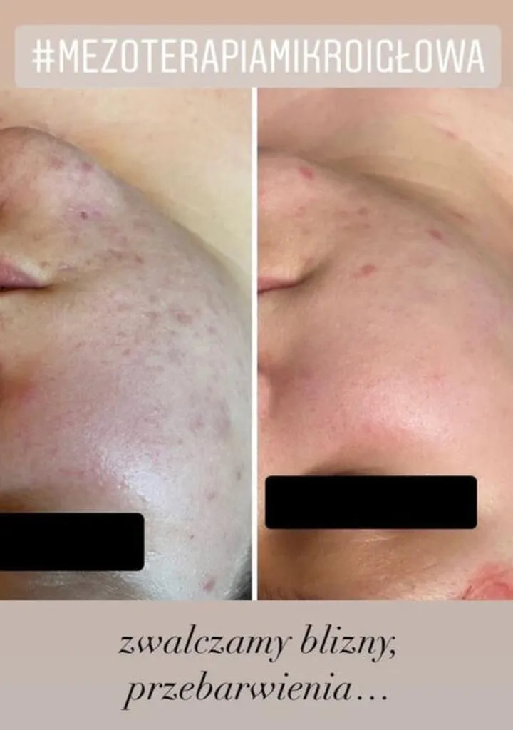 Co wiedzieć przed zabiegiem mezoterapii