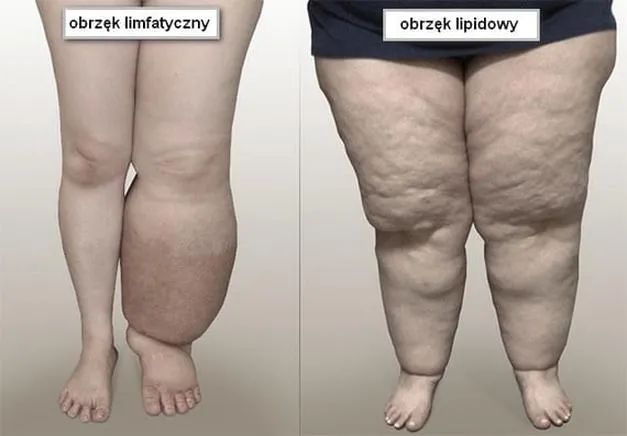 Ćwiczenia na obrzęk