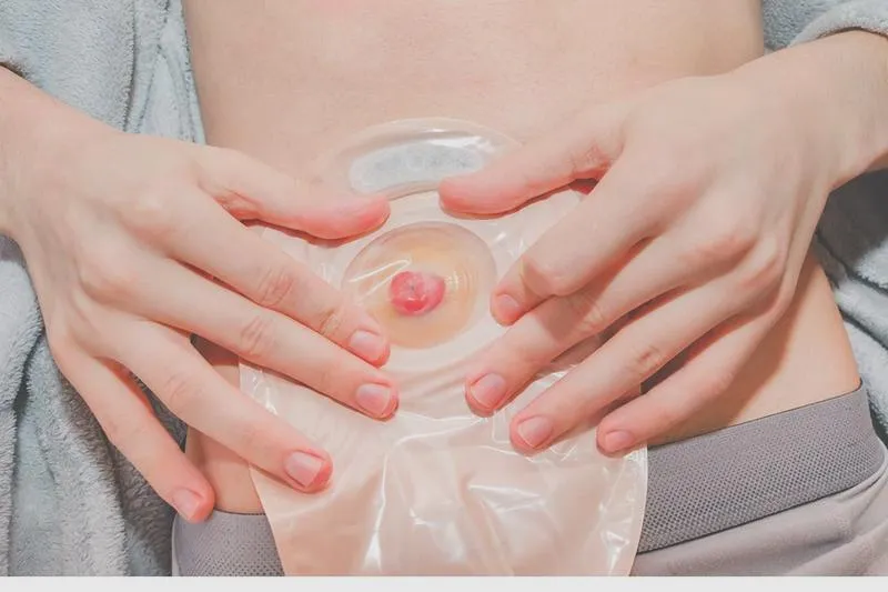 Czas hospitalizacji po zabiegu stomijnym