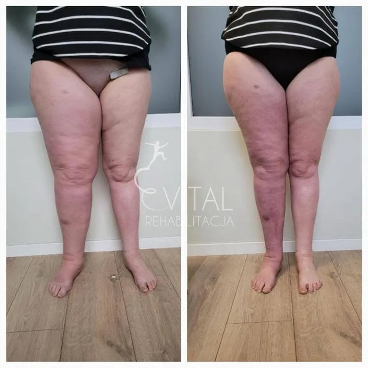 Dieta przy obrzęku limfatycznym