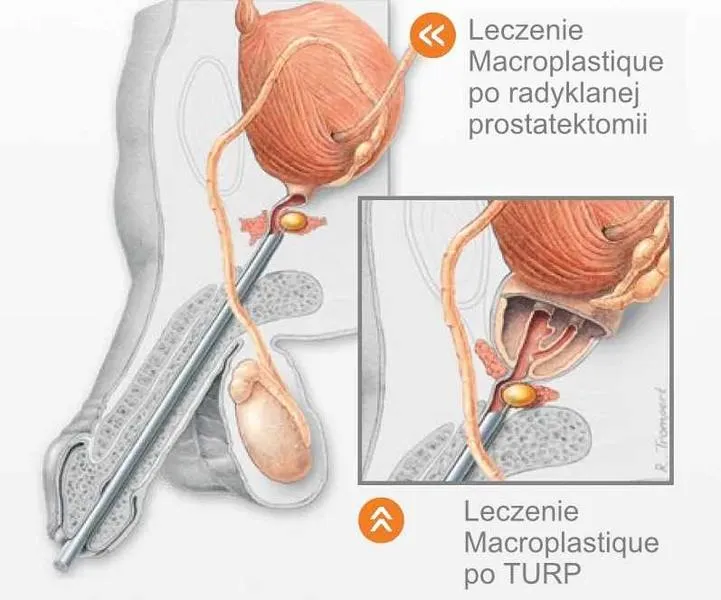 Leczenie nietrzymania moczu