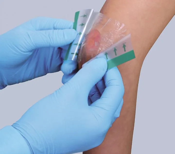 Medisorb F w leczeniu ran