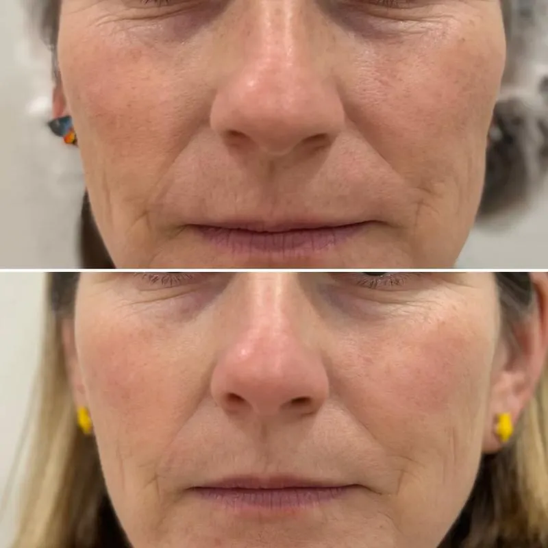 Mezoterapia igłowa odmładzanie skóry