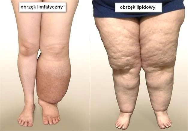 Obrzęk limfatyczny